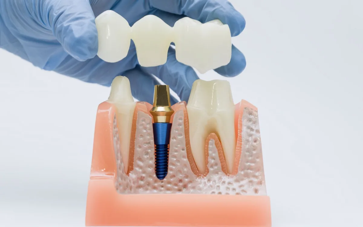 Comparație vizuală între implant dentar și punte dentară